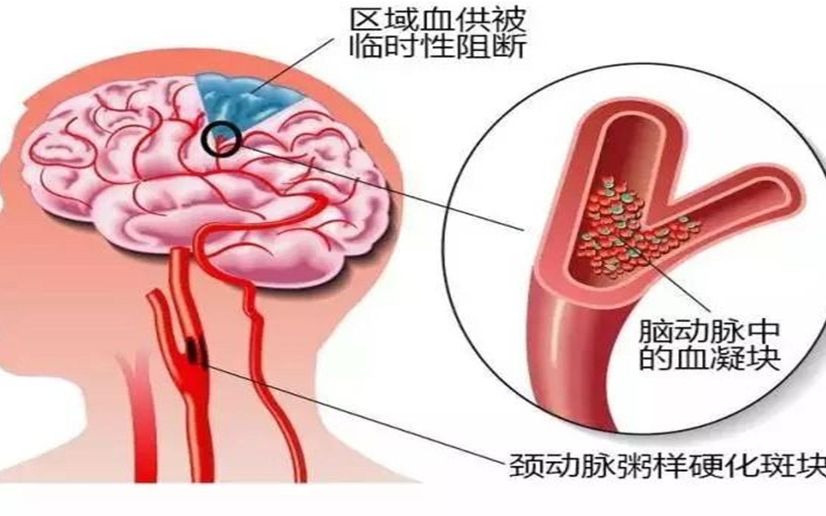 颈动脉斑块治疗新突破药物揭晓