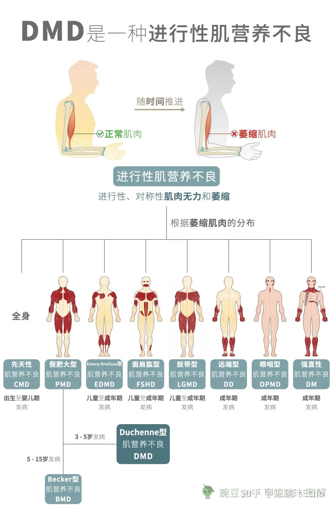 创新疗法应对肌营养不良挑战